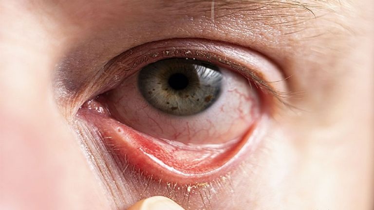 Bệnh viêm giác mạc – Nguyên nhân, dấu hiệu và cách phòng ngừa hiệu quả